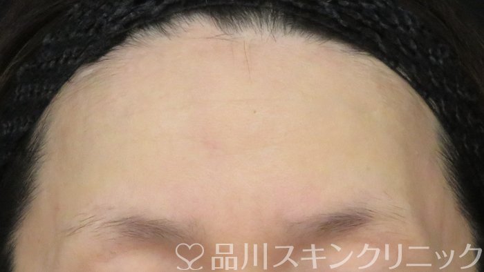 症例NO.71901のBEFORE写真