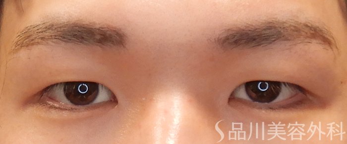 症例NO.69804のBEFORE写真