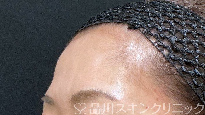 症例NO.73481のBEFORE写真