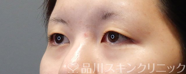 症例NO.74493のBEFORE写真