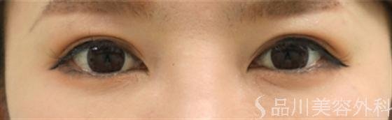 症例NO.13456のBEFORE写真