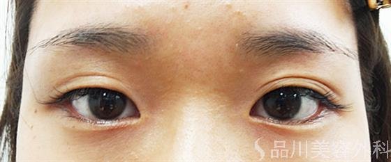 症例NO.25301のBEFORE写真
