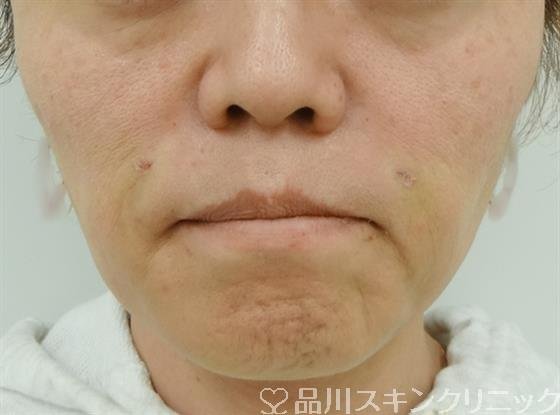 症例NO.30506のAFTER写真