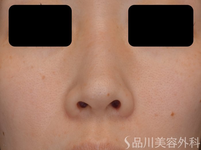 症例NO.72974のBEFORE写真