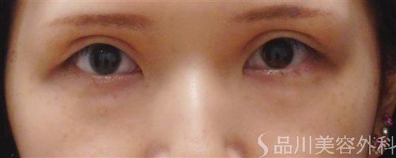 症例NO.35082のAFTER写真