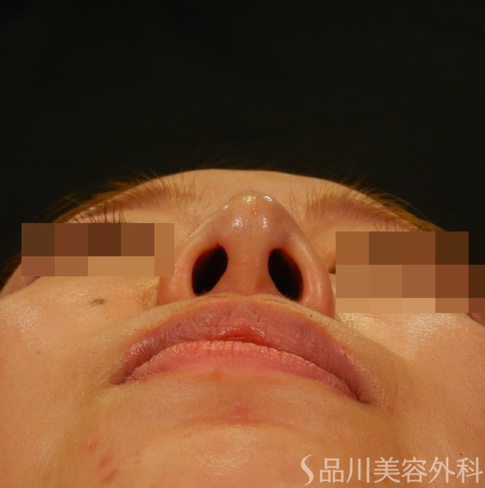 症例NO.65003のAFTER写真