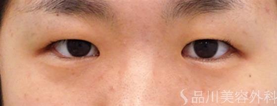 症例NO.54185のBEFORE写真