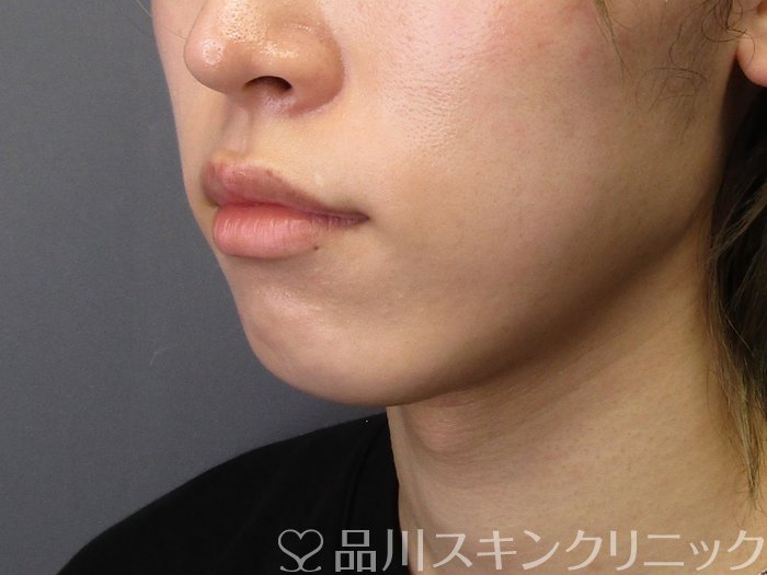 症例NO.75070のBEFORE写真