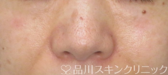 症例NO.64406のAFTER写真