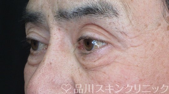 症例NO.70411のBEFORE写真