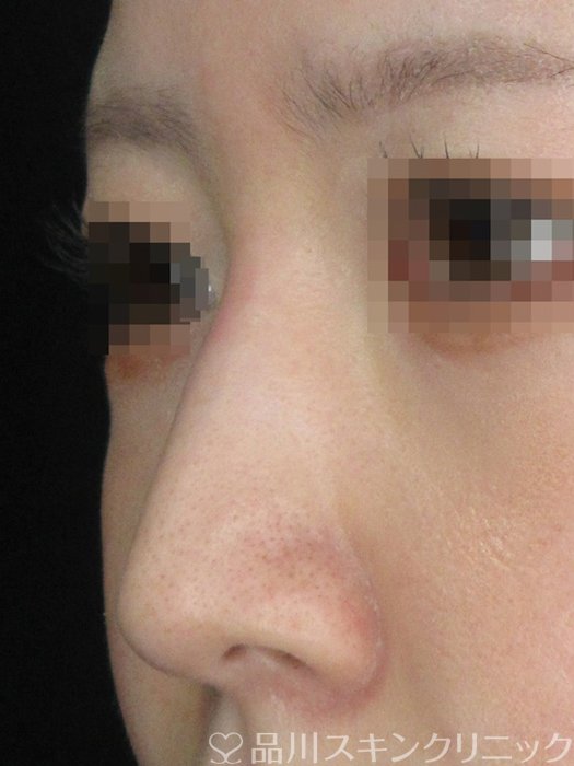 症例NO.69532のBEFORE写真