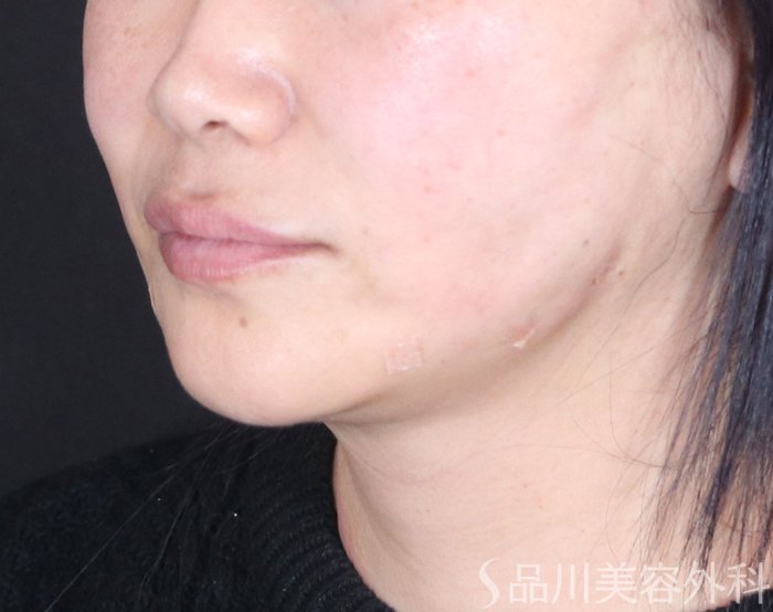 症例NO.72483のAFTER写真