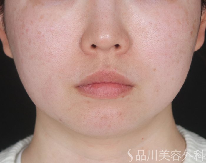 症例NO.73154のBEFORE写真