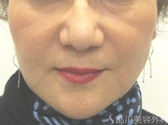 症例NO.40813のAFTER写真