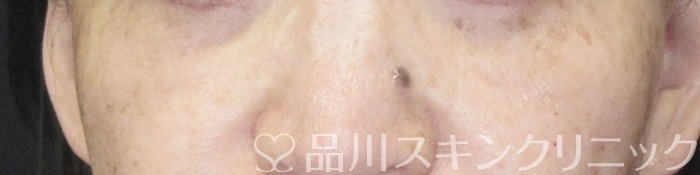 症例NO.65304のAFTER写真
