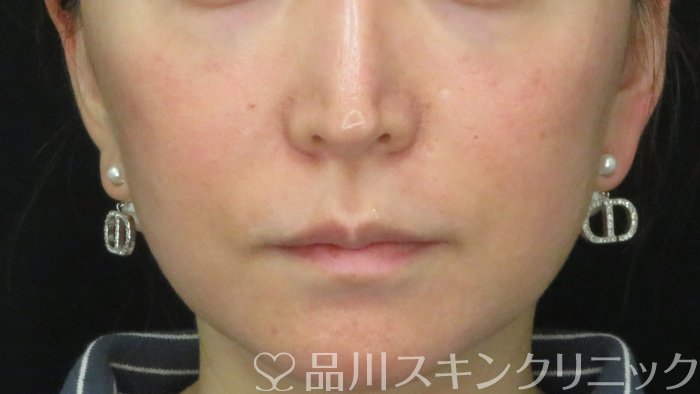 症例NO.71379のBEFORE写真