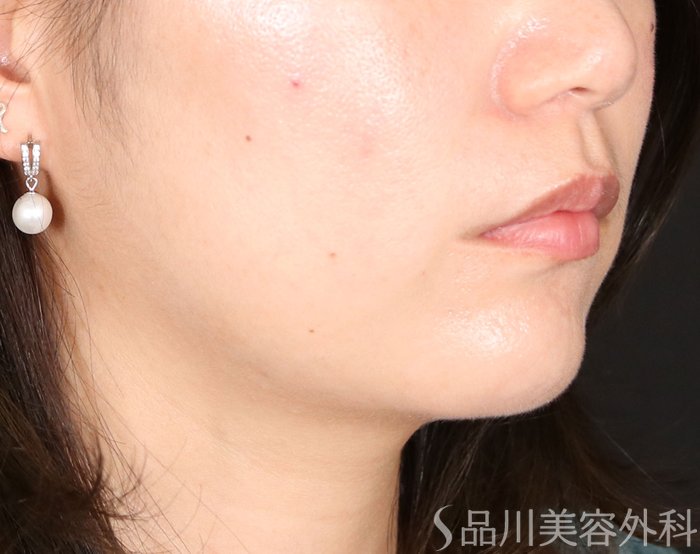 症例NO.70951のAFTER写真