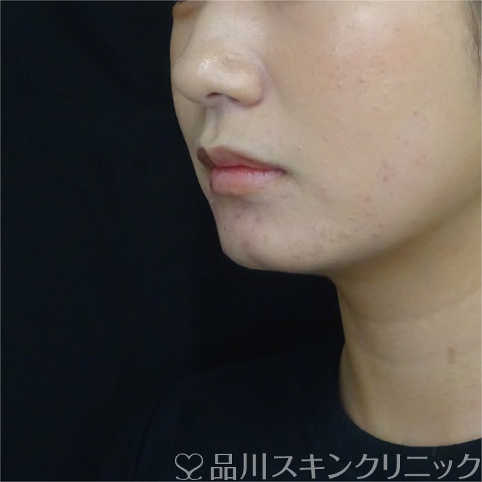症例NO.71145のBEFORE写真