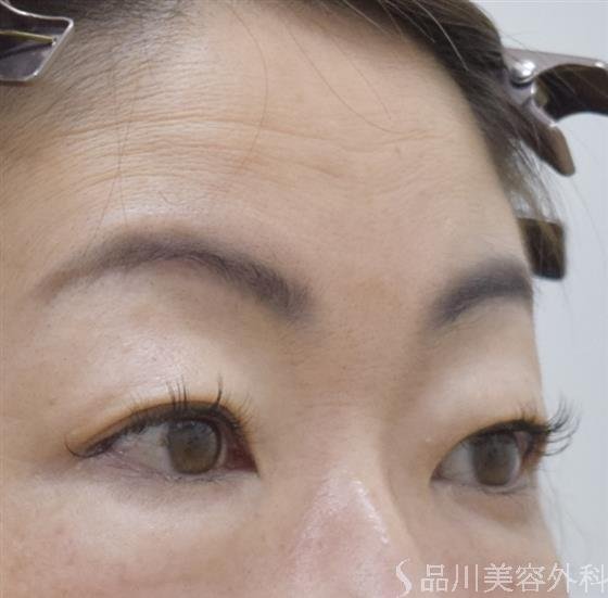 症例NO.52697のBEFORE写真