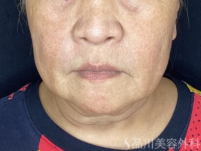 症例NO.67566のBEFORE写真
