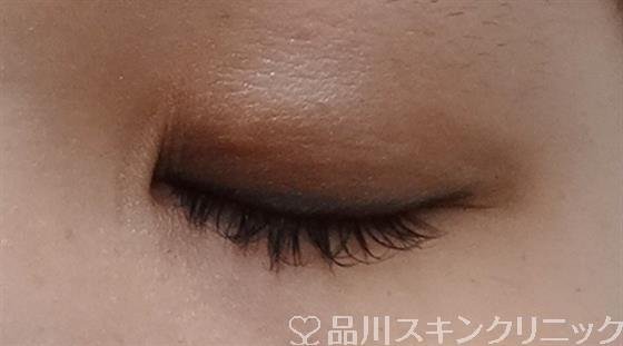 症例NO.28436のAFTER写真