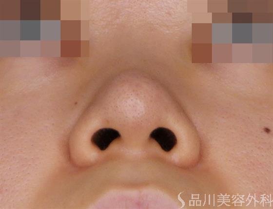 症例NO.49499のAFTER写真