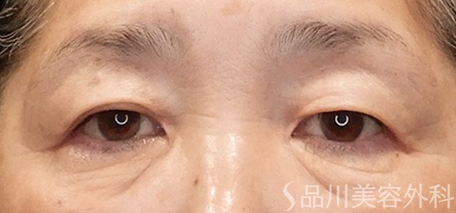 症例NO.72485のBEFORE写真