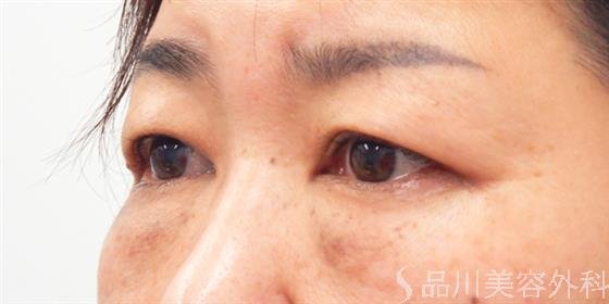 症例NO.53706のBEFORE写真