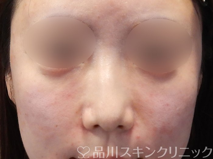 症例NO.72695のAFTER写真