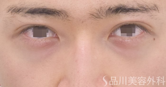 症例NO.64672のBEFORE写真