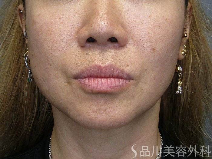 症例NO.75204のBEFORE写真