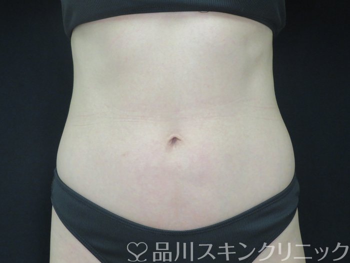症例NO.70144のAFTER写真