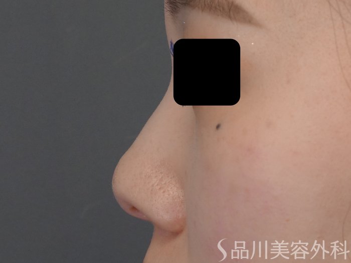症例NO.69601のBEFORE写真