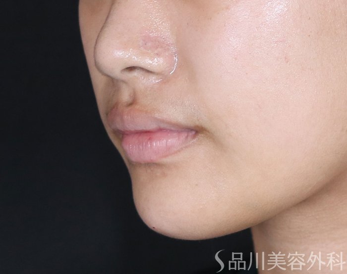 症例NO.72333のAFTER写真