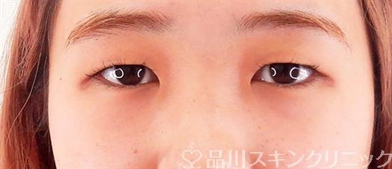 症例NO.59642のBEFORE写真