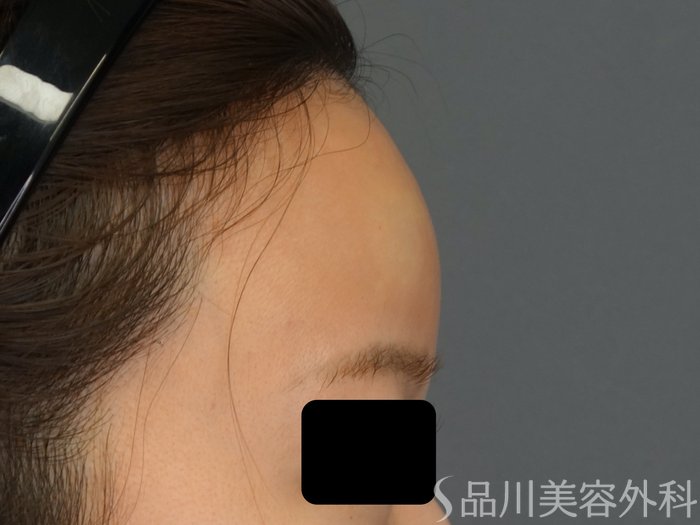 症例NO.69293のAFTER写真