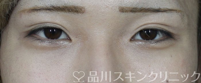 症例NO.65735のAFTER写真