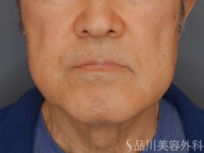 症例NO.71970のBEFORE写真
