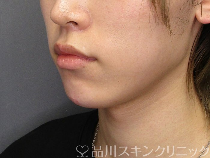 症例NO.75070のAFTER写真