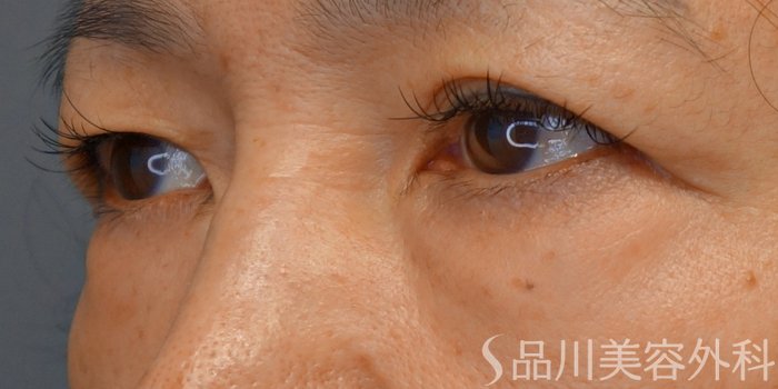 症例NO.72222のBEFORE写真