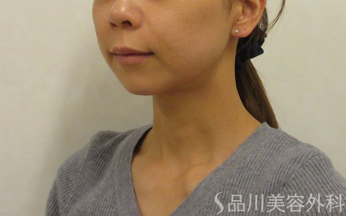 症例NO.74161のBEFORE写真