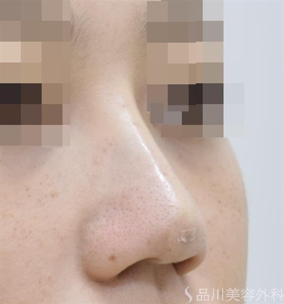 症例NO.44115のAFTER写真