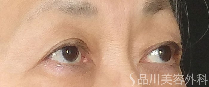 症例NO.71564のBEFORE写真