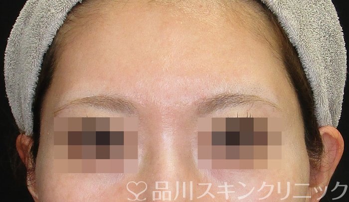 症例NO.74118のBEFORE写真