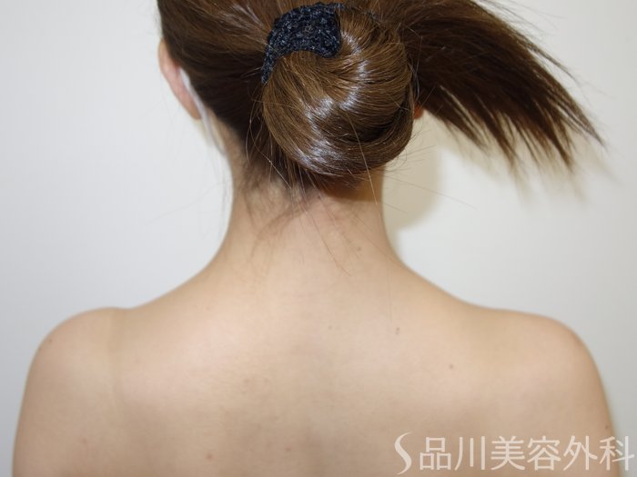 症例NO.73179のAFTER写真