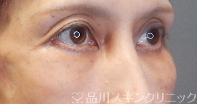 症例NO.67975のAFTER写真