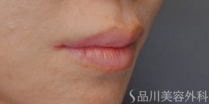 症例NO.71258のBEFORE写真