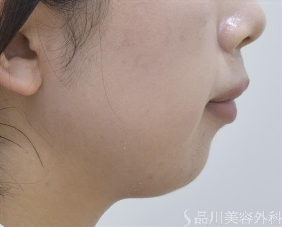 症例NO.46844のBEFORE写真