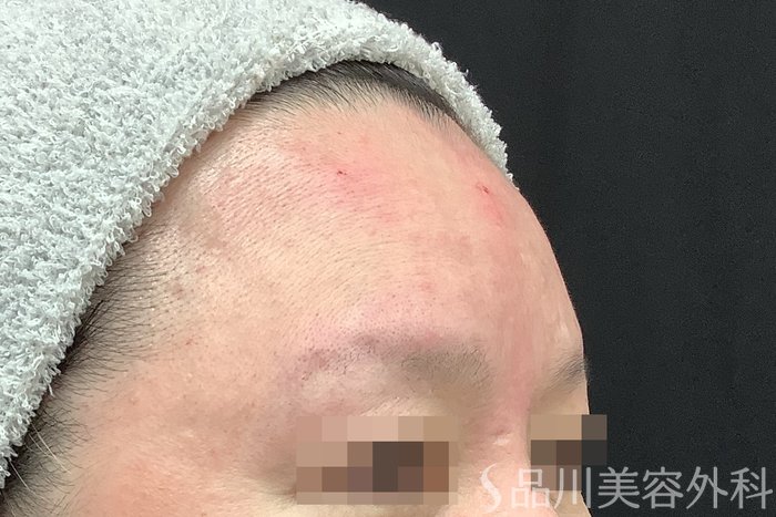 症例NO.67802のAFTER写真