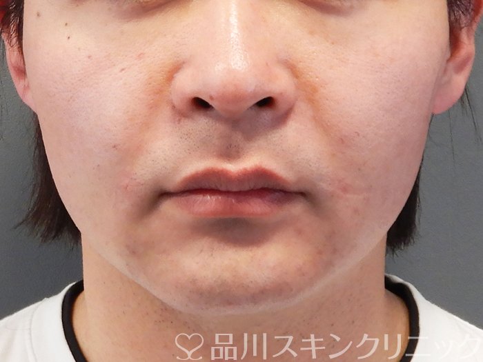 症例NO.70724のAFTER写真